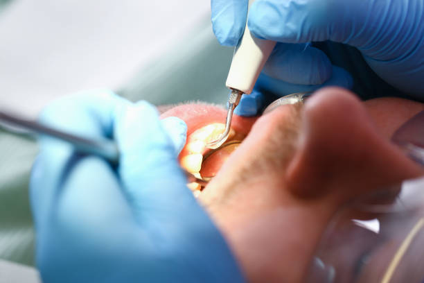 Best Emergency Wisdom Tooth Extraction in Gardiner, ME